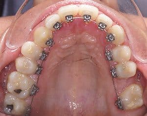 découvrez notre sélection de couleurs pour bagues d'appareil dentaire. personnalisez votre sourire avec des tons éclatants et tendances qui reflètent votre style tout en bénéficiant d'un traitement orthodontique efficace.